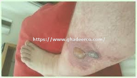 شركة مكافحة البق ببقيق